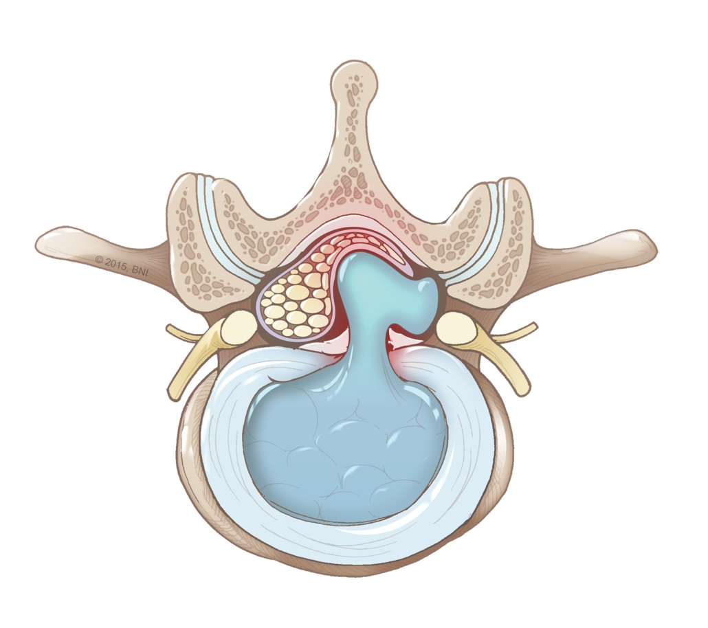 Patient considering artificial disc replacement surgery reviews a non-surgical alternative with Dr. Michael Karr at Los Angeles Spinal Decompression®, using the FDA-cleared DRX9000 spinal decompression system to treat a herniated or damaged disc without implants, incisions, or general anesthesia in Los Angeles.